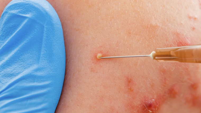 How to Find the Best Acne Doctor in Oakton, VA